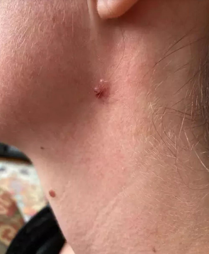 Nốt ruồi tự nhiên đổi màu sau một đêm, đi khám phát hiện bị ung thư - 1