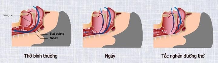 7 phương pháp đơn giản giúp giảm tình trạng ngủ ngáy - 1