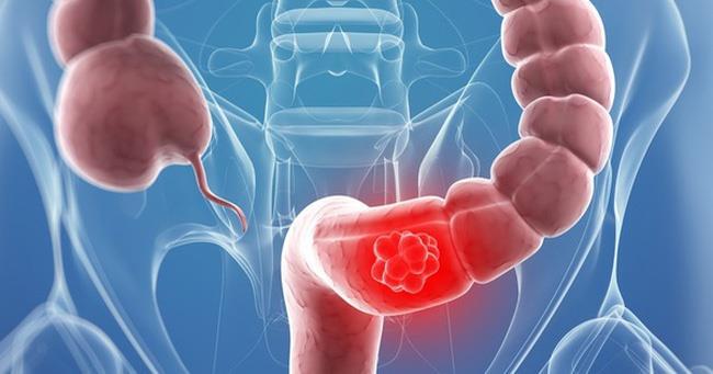 5 triệu chứng ung thư đại tràng giai đoạn cuối - 1