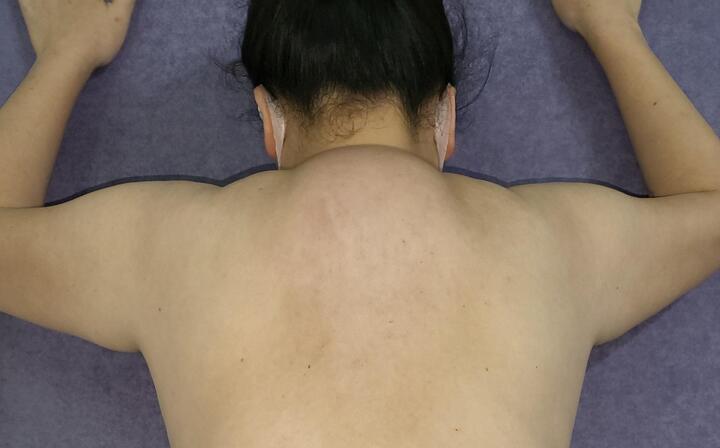 Tưởng béo, đi khám mới biết mắc bệnh hiếm gặp - 1