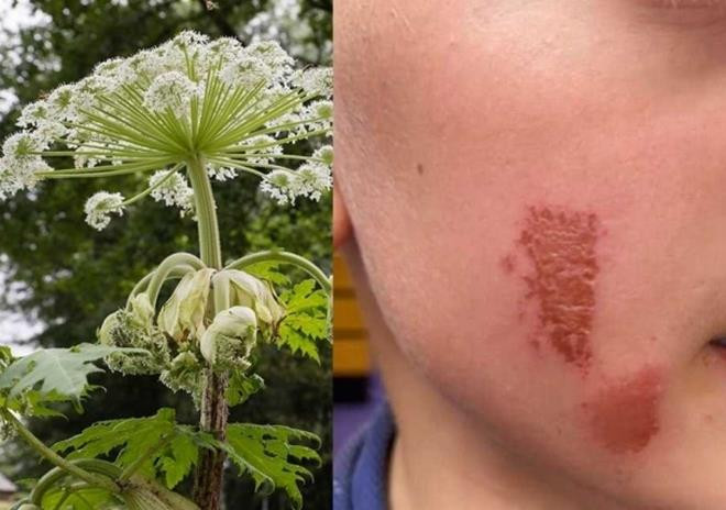 Cây 'sứ giả địa ngục' khiến bé trai bỏng mặt chỉ sau cú chạm nhẹ - 1