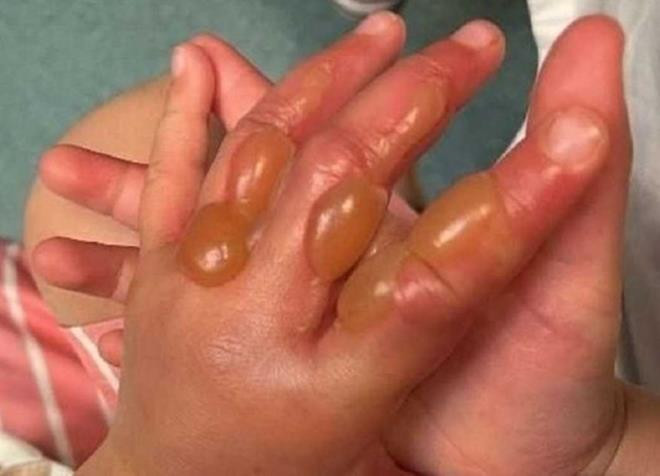 Cây 'sứ giả địa ngục' khiến bé trai bỏng mặt chỉ sau cú chạm nhẹ - 3