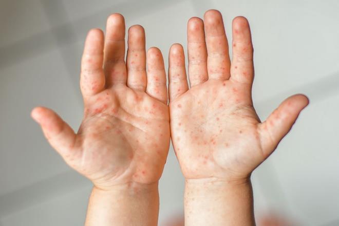 Nhiều trẻ nguy kịch vì bệnh tay chân miệng - 1