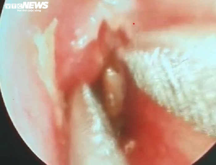 Bé gái 12 tuổi ở Hà Tĩnh bị gián chui vào tai - 1