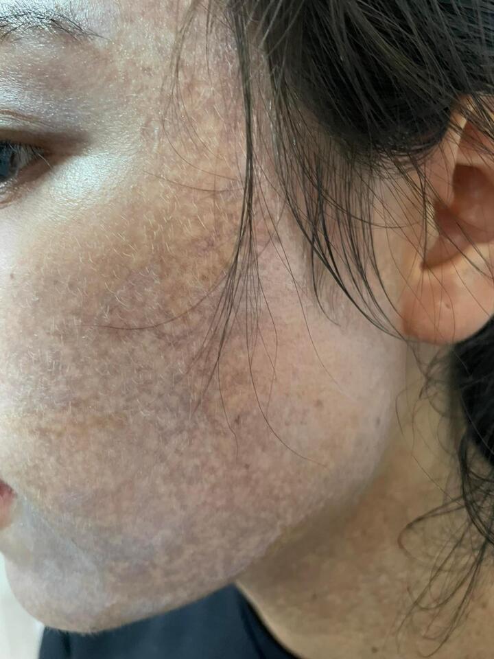 Mặt 'cháy đen' vì lăn kim, lột da bằng hóa chất vô tội vạ - 1