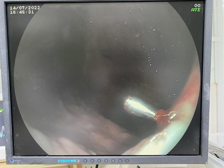 Diễn viên xiếc rách dạ dày, nôn ra máu sau khi biểu diễn nuốt mảnh thuỷ tinh - 2