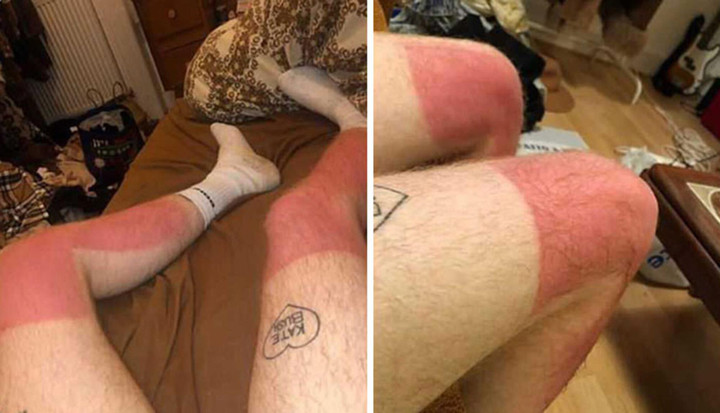 Hàng loạt vết tích cháy nắng hài không đỡ được vì lỡ coi thường cái nắng hè - 5