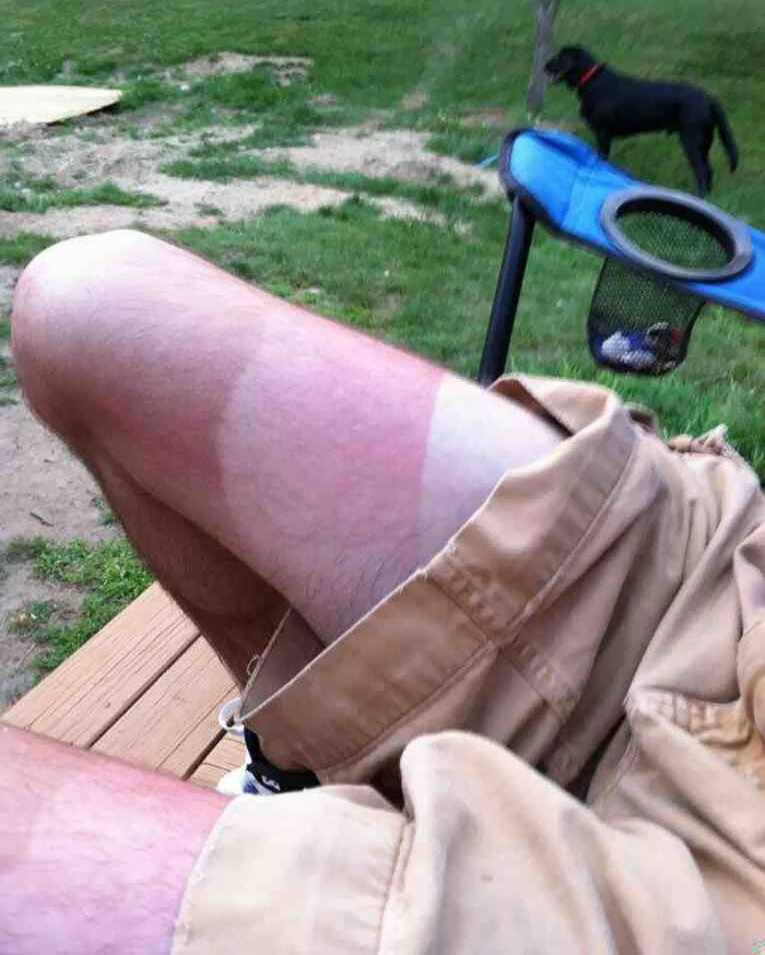 Hàng loạt vết tích cháy nắng hài không đỡ được vì lỡ coi thường cái nắng hè - 9