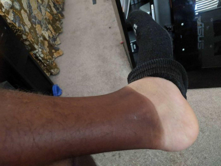 Hàng loạt vết tích cháy nắng hài không đỡ được vì lỡ coi thường cái nắng hè - 2