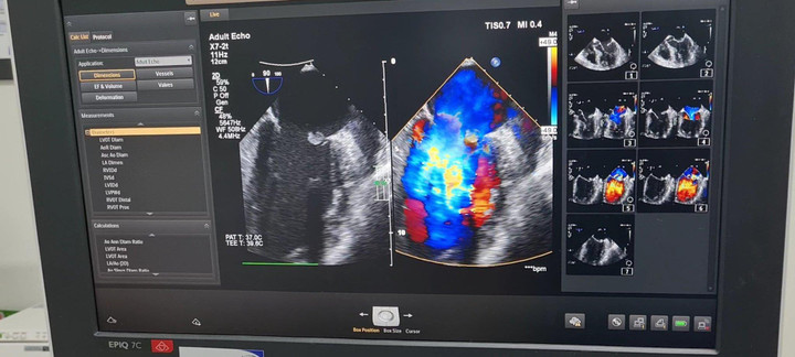 Hoại tử ruột, nhiễm trùng máu và tim do tiêm giảm đau vào khớp - 1