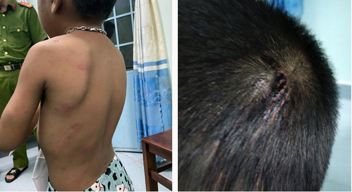 Bắt giam người cha hành hạ, đánh đập dã man bé trai 6 tuổi - 2