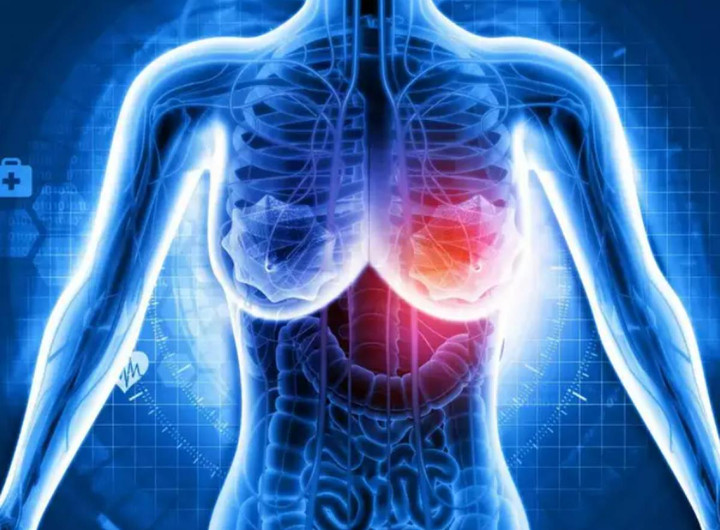 Thực phẩm bạn đang ăn có làm tăng nguy cơ ung thư vú? - 3