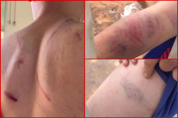 Khởi tố cha và bà nội đánh đập dã man cháu bé 9 tuổi ở Đắk Lắk - 1