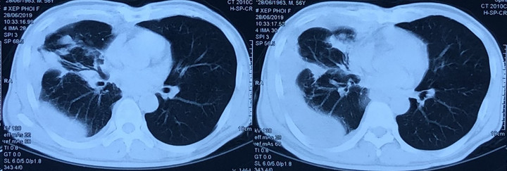 Tiền sử khỏe mạnh, nhiều người phát hiện ung thư phổi sau cơn đau ngực, ho khan - 1