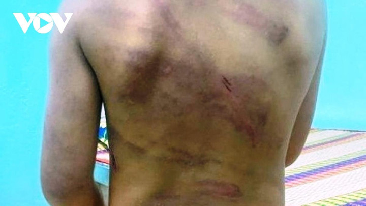 Làm đổ cơm khi ăn, bé gái 7 tuổi ở Bình Phước bị cha dượng đánh đập dã man - 2