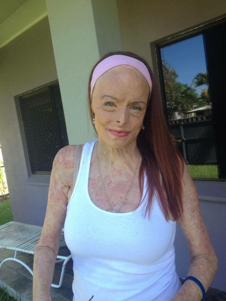 Hành trình tìm lại sự ‘sống’ của cựu hoa hậu bị bỏng gần hết cơ thể sau đám cháy - 2