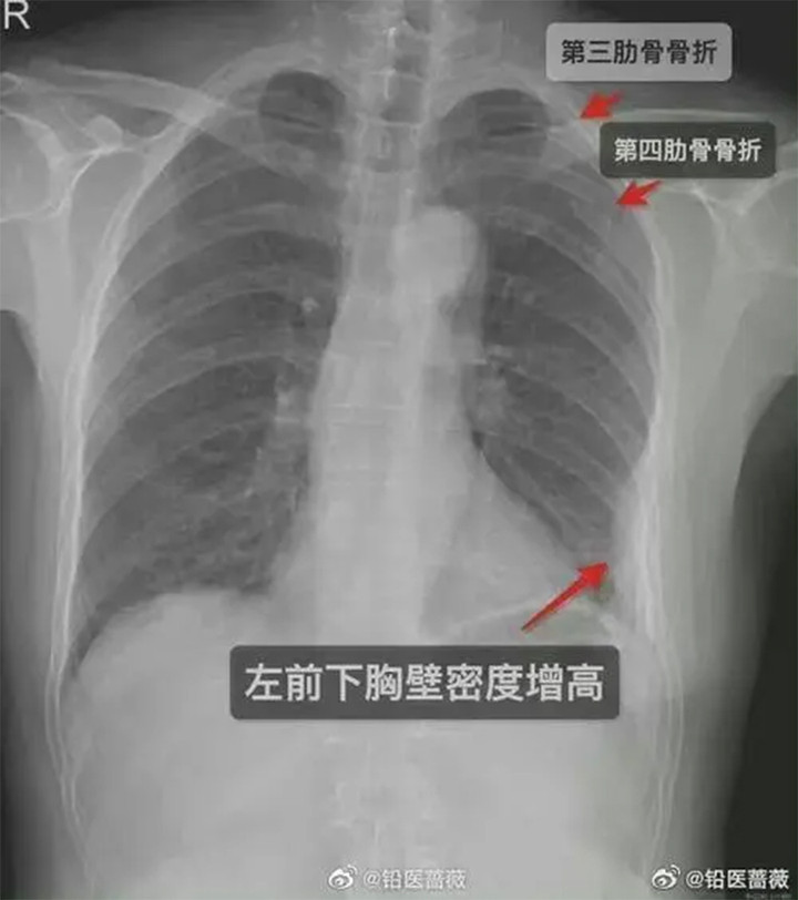 Cô gái bị nam đồng nghiệp ôm đến gãy xương sườn - 1