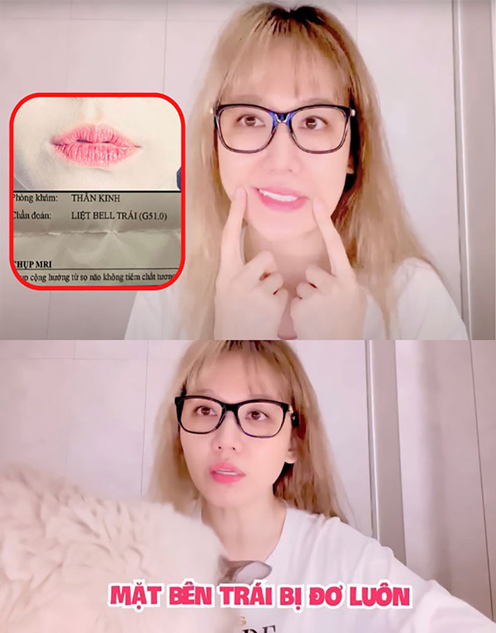 Không chỉ Hari Won, nhiều ngôi sao cũng từng suy sụp khi bị liệt nửa mặt - 1