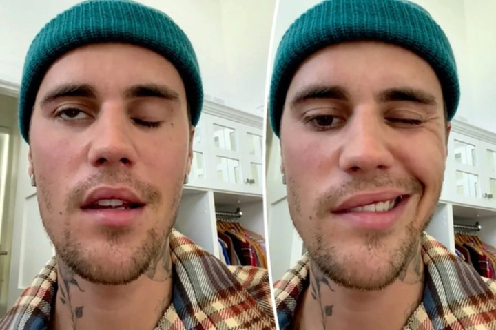 Không chỉ Hari Won, nhiều ngôi sao cũng từng suy sụp khi bị liệt nửa mặt - 3