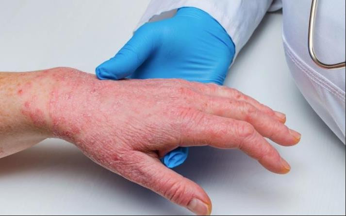 Mỹ ban bố tình trạng khẩn cấp toàn quốc vì bệnh đậu mùa khỉ - 1