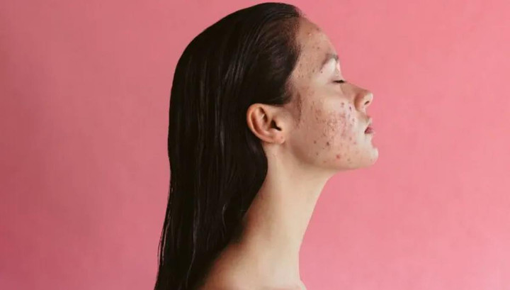 Ăn gì để hết mụn? - 1