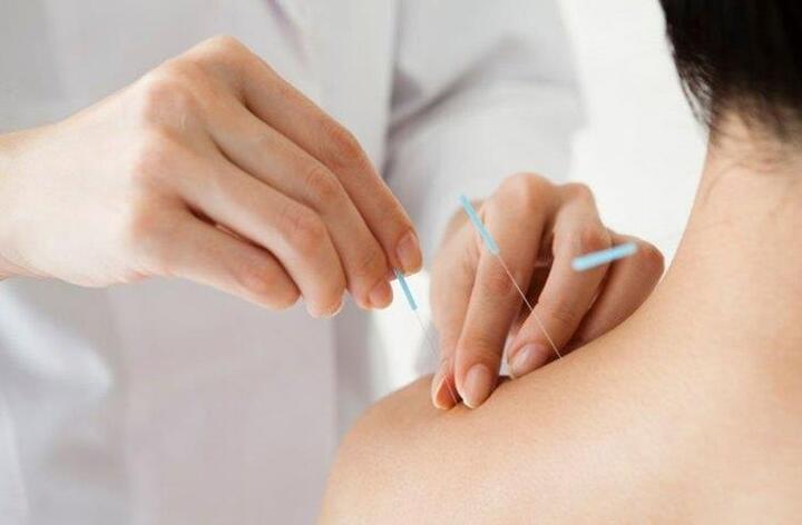 Các lợi ích sức khoẻ tiềm năng khi châm cứu - 1