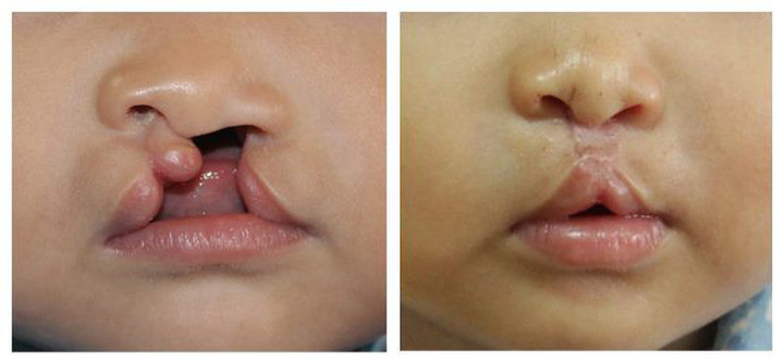 Chìa khoá cải thiện cuộc sống của bệnh nhân khe hở môi – vòm - 1
