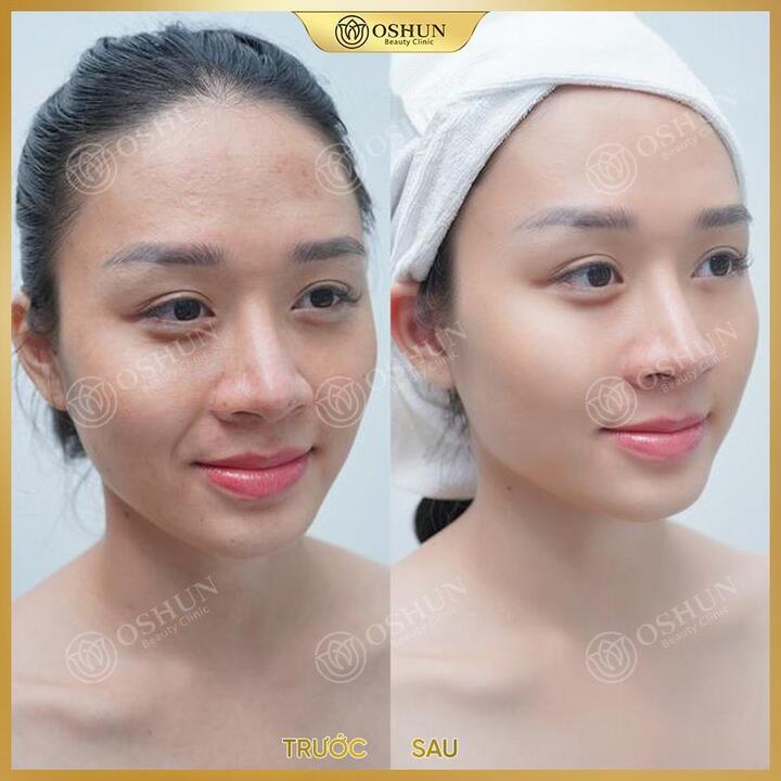 Ultherapy & Thermage FLX - Công nghệ trẻ hóa xóa nhăn, căng da tức thì - 2