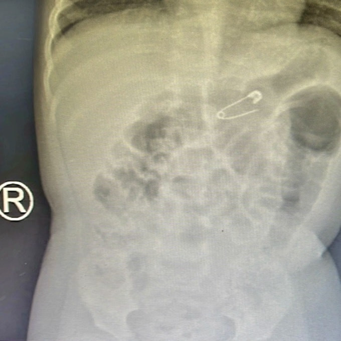 Bé 6 tháng tuổi suýt bị kim băng đâm thủng dạ dày - 1