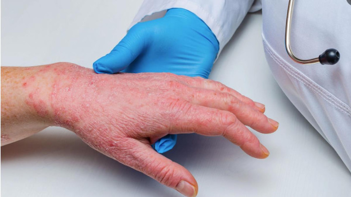 Người nhập cảnh từ nơi có đậu mùa khỉ phải tự theo dõi sức khỏe trong 21 ngày - 1