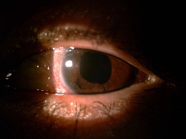 Bị nước rửa xe bắn vào mắt, người đàn ông mờ, loá suốt 4 tháng - 1