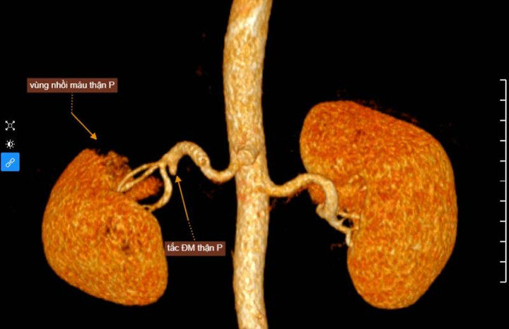 Đau bụng 3 ngày đi khám phát hiện bệnh lý hiếm gặp ở thận - 1