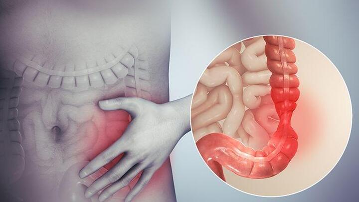 Viêm loét đại tràng và nỗi lo biến chứng - 1