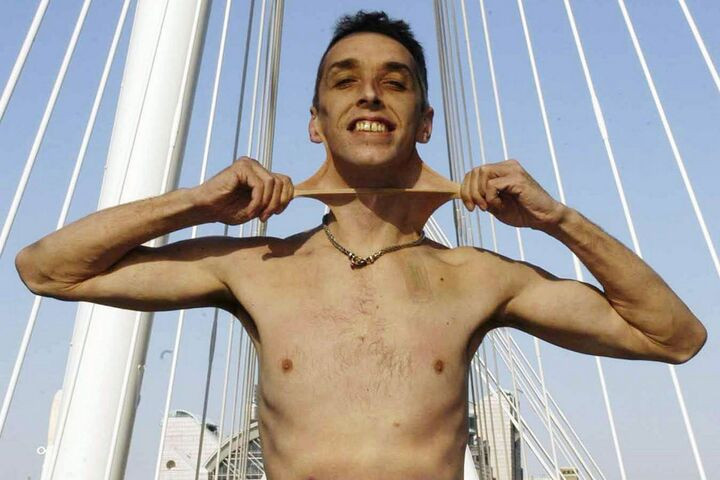 Người đàn ông có ‘làn da cao su’ kéo giãn tùy thích, 20 năm qua chưa có đối thủ - 2