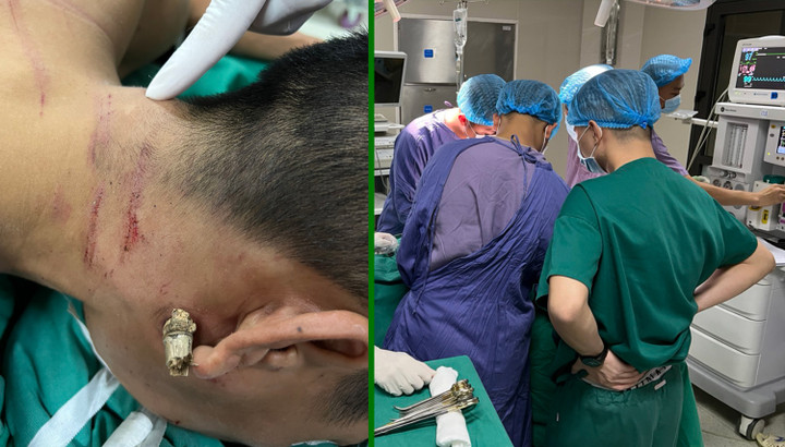 Phú Thọ: Cứu sống nam thanh niên bị tre đâm xuyên cổ - 1