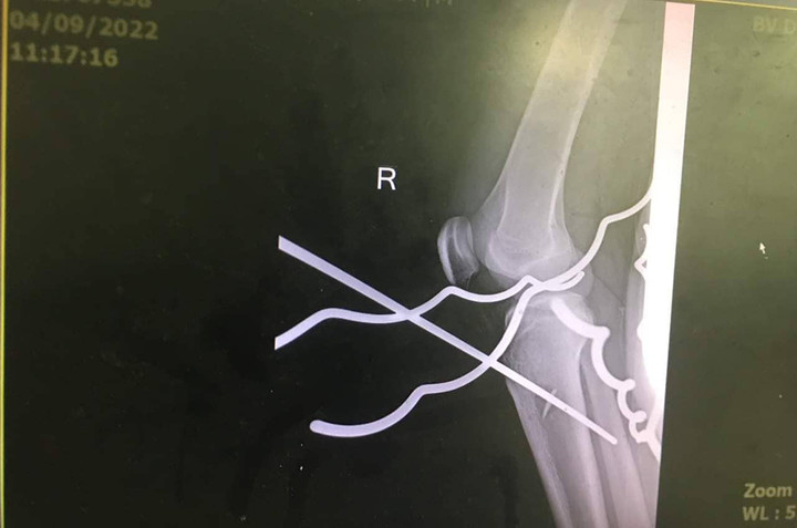 Nam thanh niên ở Quảng Ngãi bị 5 thanh sắt đâm xuyên chân - 1