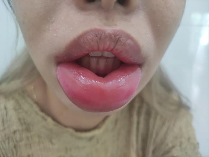 Hai cô gái đi làm đẹp, miệng biến dạng như cá hô - Ảnh 1. Hai cô gái đi làm đẹp, miệng biến dạng như 'cá hô' - 1