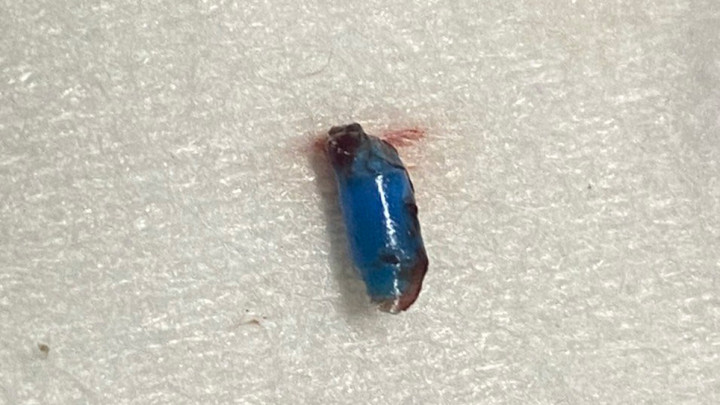 Bé 4 tuổi suýt điếc vì bạn học nhét đồ chơi vào tai - 1