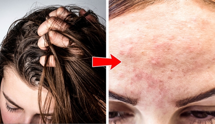 Vị trí mụn trứng cá tiết lộ thói quen, lối sống của bạn - 2