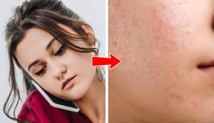 Vị trí mụn trứng cá tiết lộ thói quen, lối sống của bạn - 4