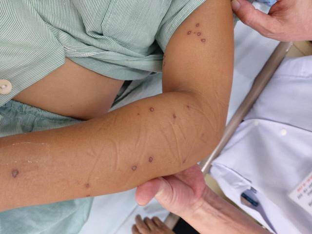 Người phụ nữ trẻ nguy kịch vì bị 70 nốt ong vò vẽ đốt - Ảnh 1. Bị ong vò vẽ đốt 70 nốt, người phụ nữ trẻ nguy kịch - 1