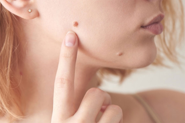 Có nên xóa nốt ruồi? - 1