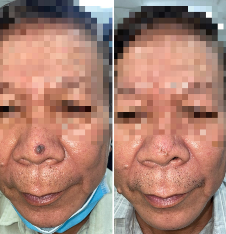 Cảnh báo ung thư da ở người cao tuổi - 1