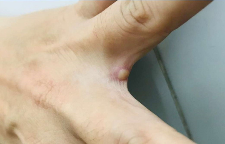 Hình ảnh bóng nước ở bệnh nhân mắc đậu mùa khỉ đầu tiên tại Việt Nam - 1