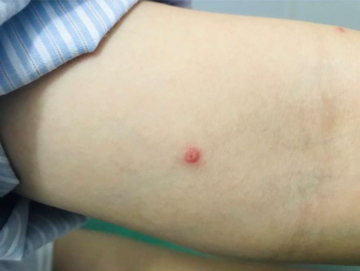 Hình ảnh bóng nước ở bệnh nhân mắc đậu mùa khỉ đầu tiên tại Việt Nam