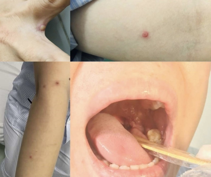 Hình ảnh bóng nước ở bệnh nhân mắc đậu mùa khỉ đầu tiên tại Việt Nam - 3