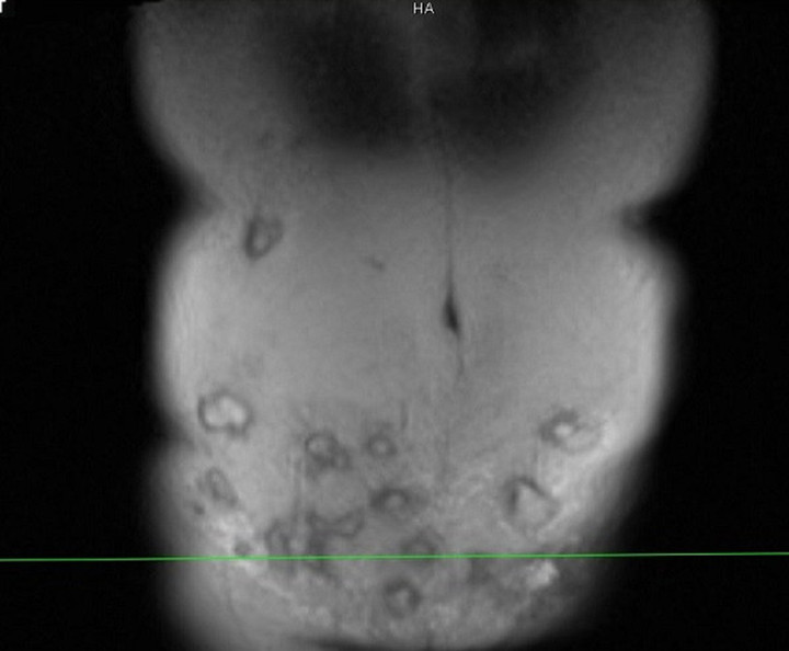 Người phụ nữ bị hoại tử vùng bụng sau khi tiêm tan mỡ - 1