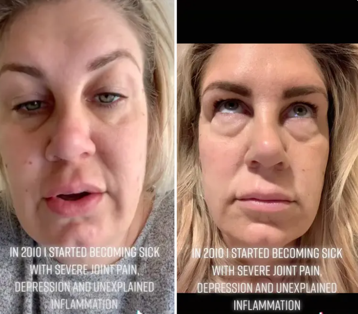 Tháo túi nâng ngực sau 8 năm mắc bệnh không rõ lý do, sốc khi thấy thứ bên trong - 1