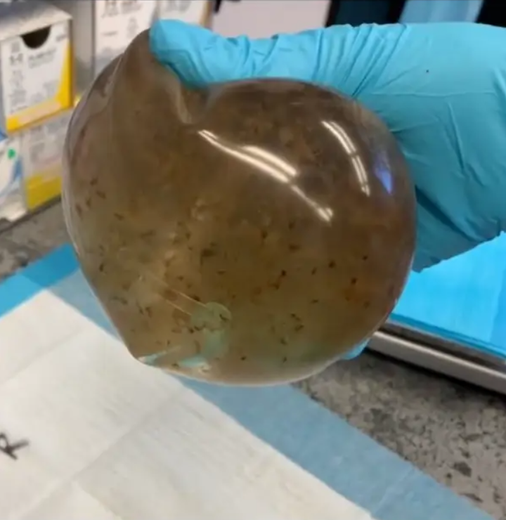 Tháo túi nâng ngực sau 8 năm mắc bệnh không rõ lý do, sốc khi thấy thứ bên trong - 4