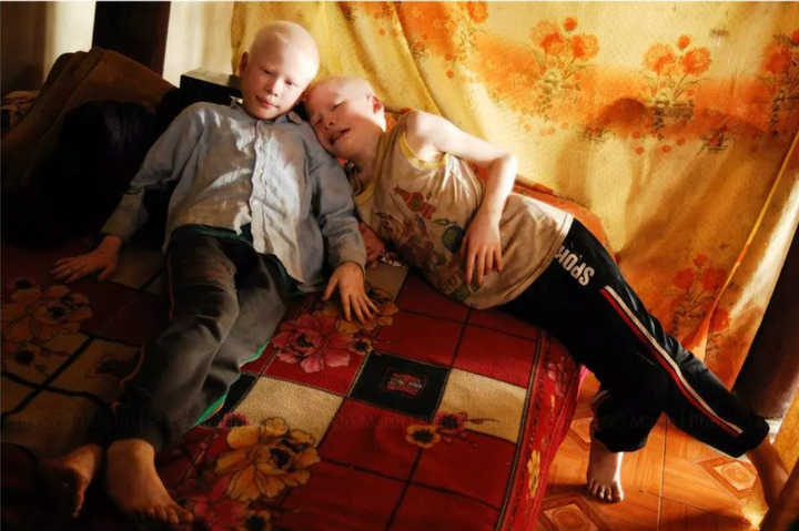 Cuộc sống của cặp song sinh bạch tạng từng nghỉ học để kiếm sống hiện ra sao? - 2